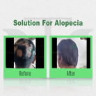 Solution For Alopecia 2