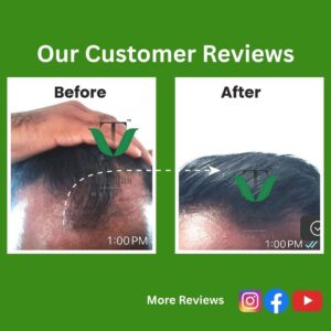 Helps Control Hair Fall I Supports Hair Growth | Useful for Bald Spots & Alopecia Areata | Helps Reduce Dandruff, Itching & Split Ends | For Long, Healthy Hair | Men & Women Helps Control Hair Fall I Supports Hair Growth | Useful for Bald Spots & Alopecia Areata | Helps Reduce Dandruff, Itching & Split Ends | For Long, Healthy Hair | Men & Women